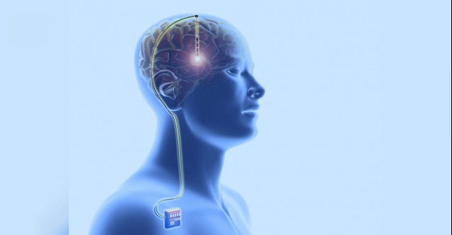 Beyin Pili Ameliyatı Tümör Ameliyatı Kadar Riskli Mi?