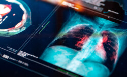 Akciğer kanserinin erken evresinde görülen 3 belirti açıklandı!